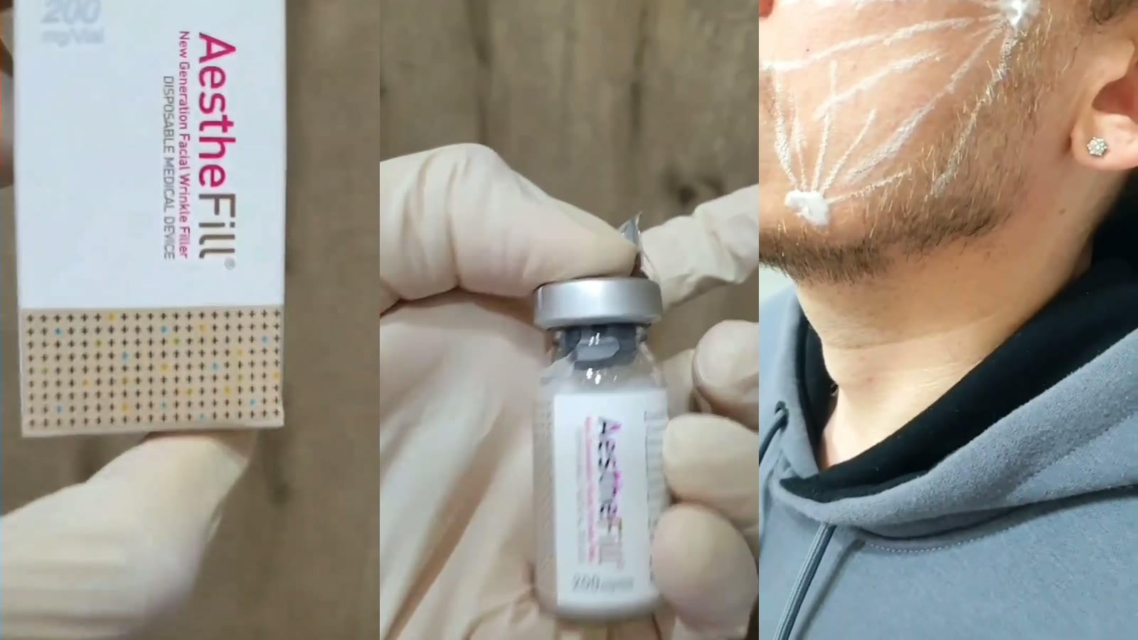 AestheFill 200 мг — упаковка, флакон и разметка лица для введения канюлей, Paramed Баку